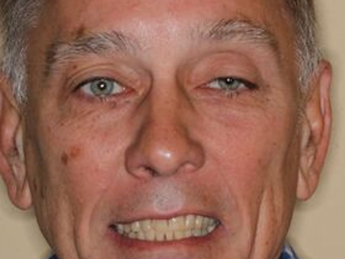 Veneers: Case 31 — before