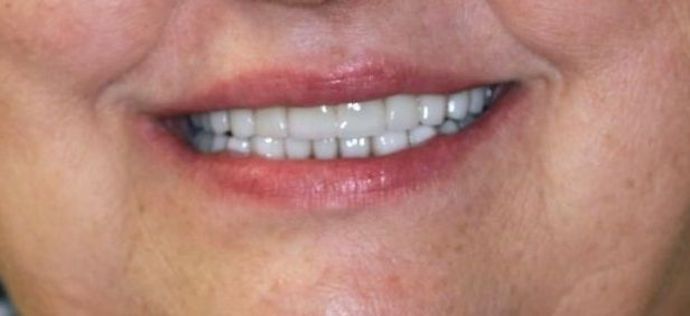 Full Mouth Reconstruction: Case 3 — after