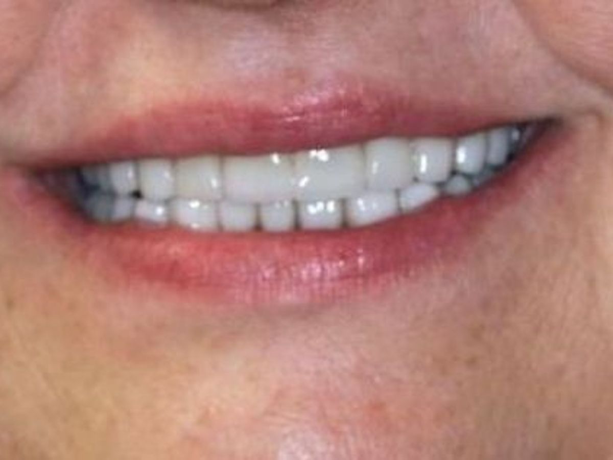 Full Mouth Reconstruction: Case 3 — after