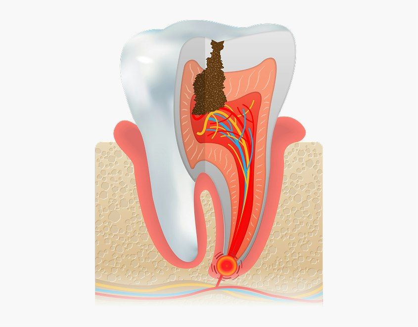 Deep tooth decay