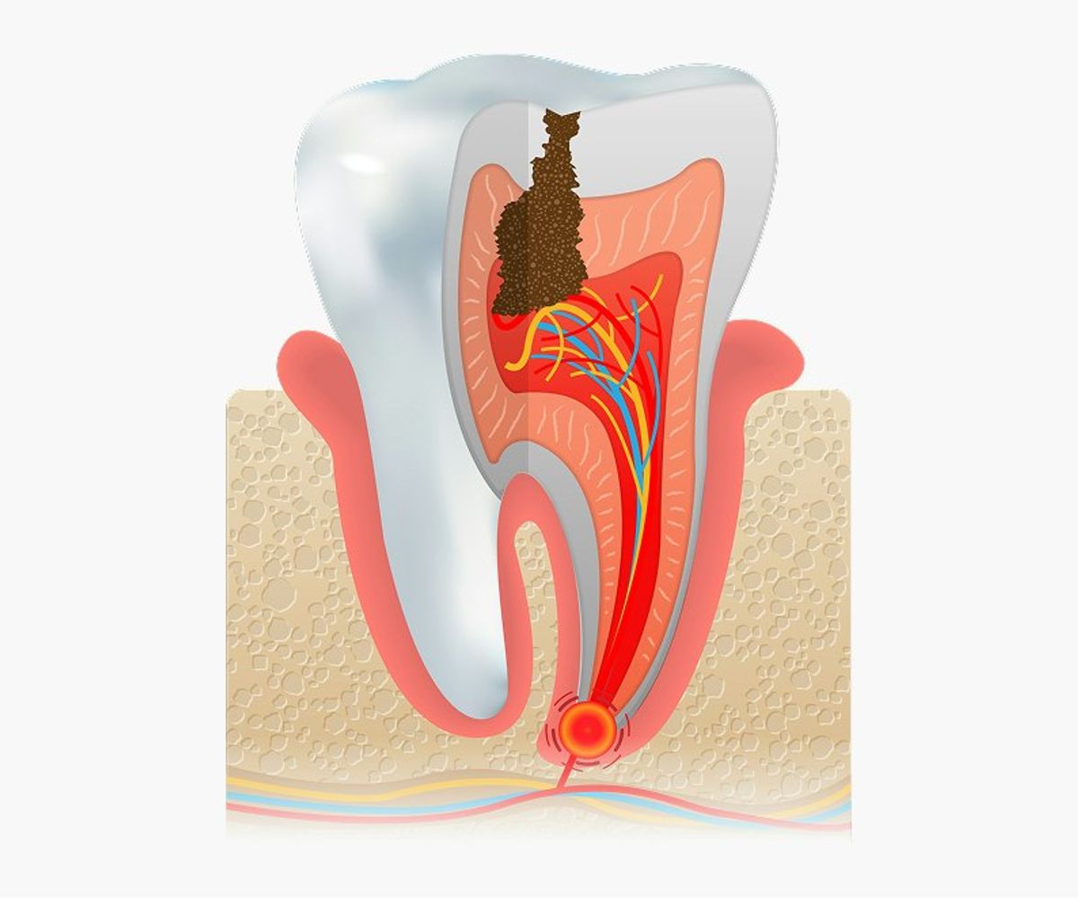 Deep tooth decay