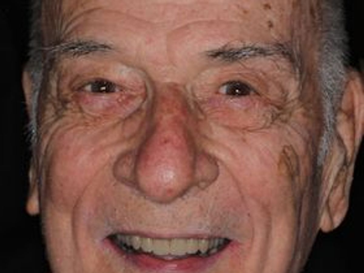 Dentures: Case 8 — after