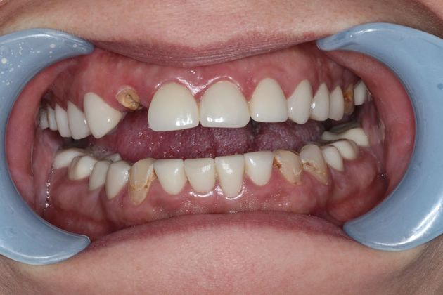 Patient's smile before dental implant treatment at Bell Dental