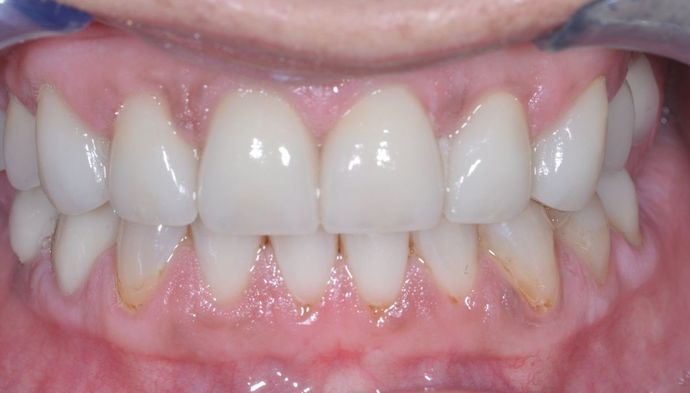 Veneers: Case 12 — after