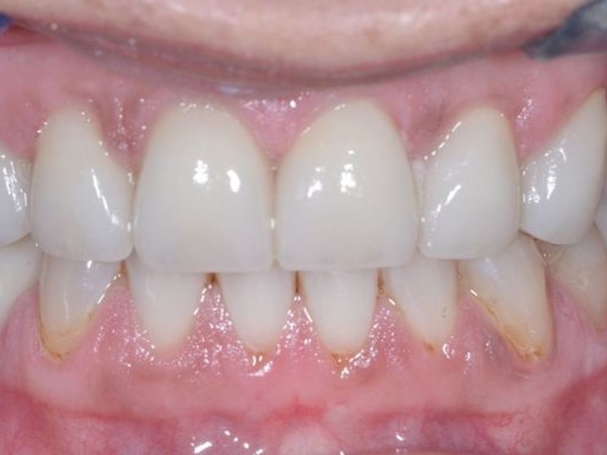 Veneers: Case 12 — after