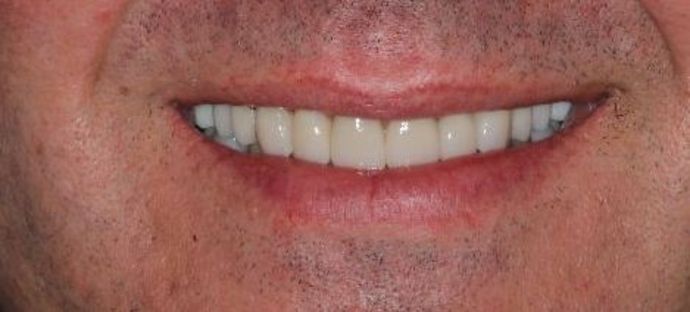 Full Mouth Reconstruction: Case 4 — after