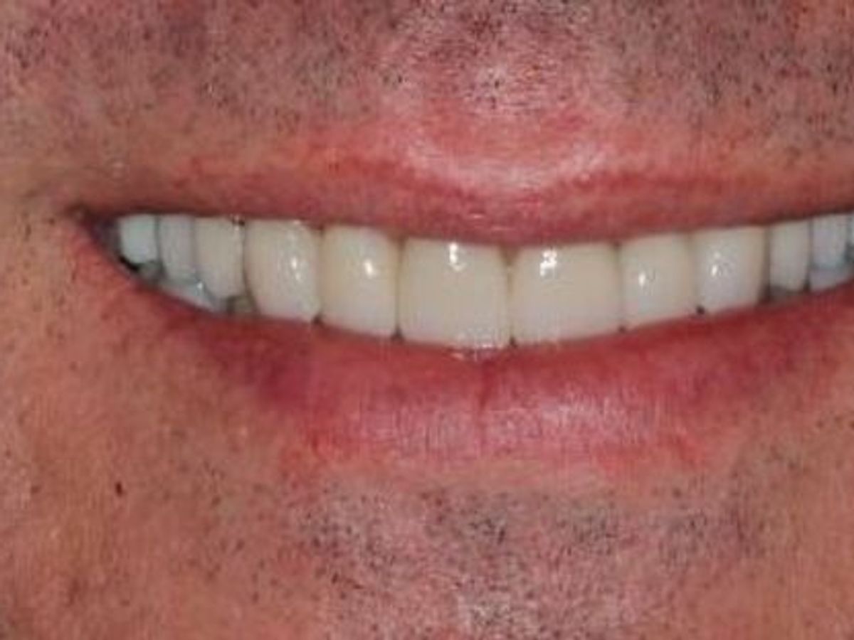 Full Mouth Reconstruction: Case 4 — after