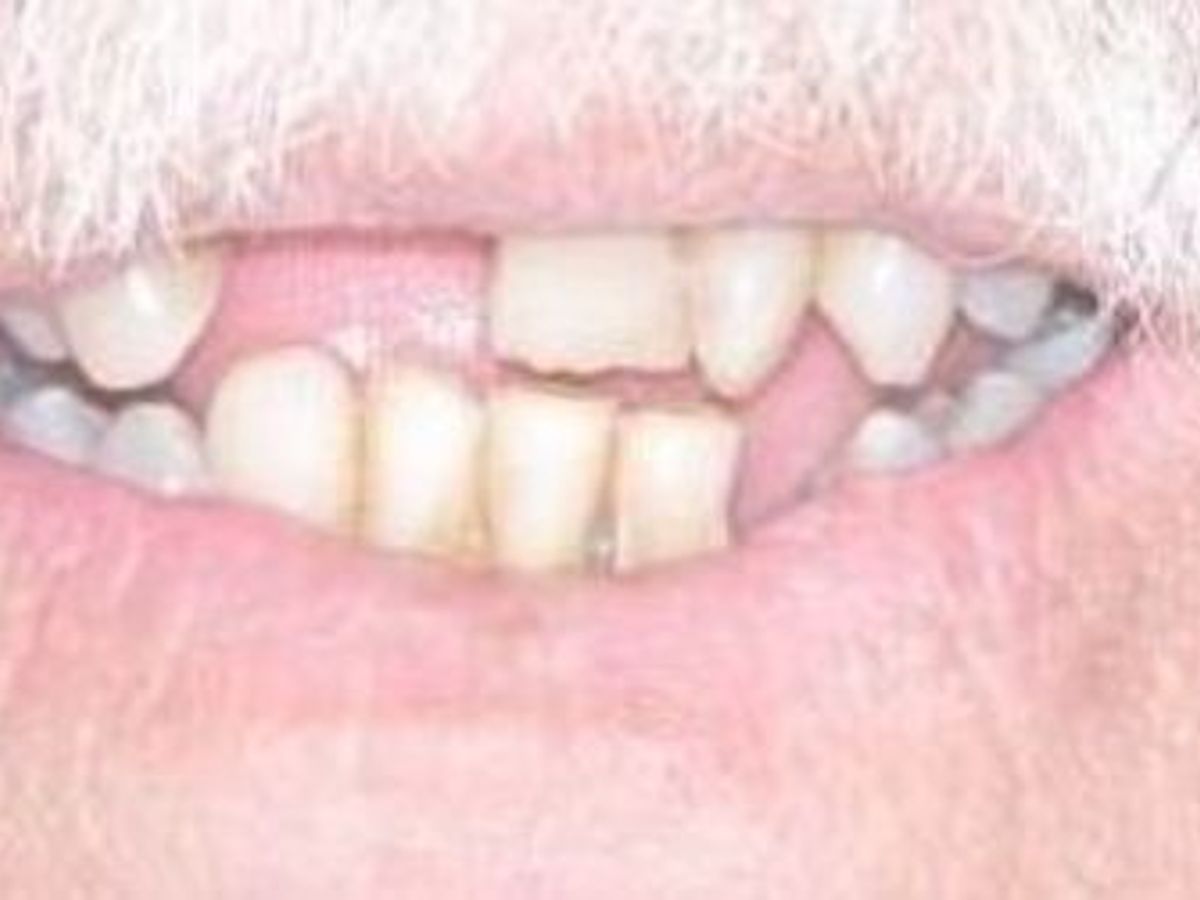 Teeth in a Day: Case 17 — before