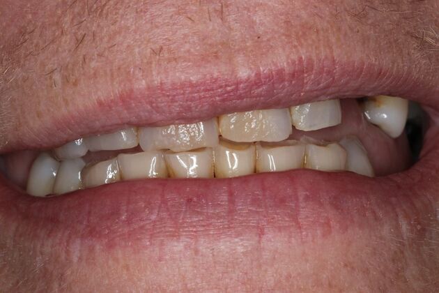 Dentures: Case 16 — before