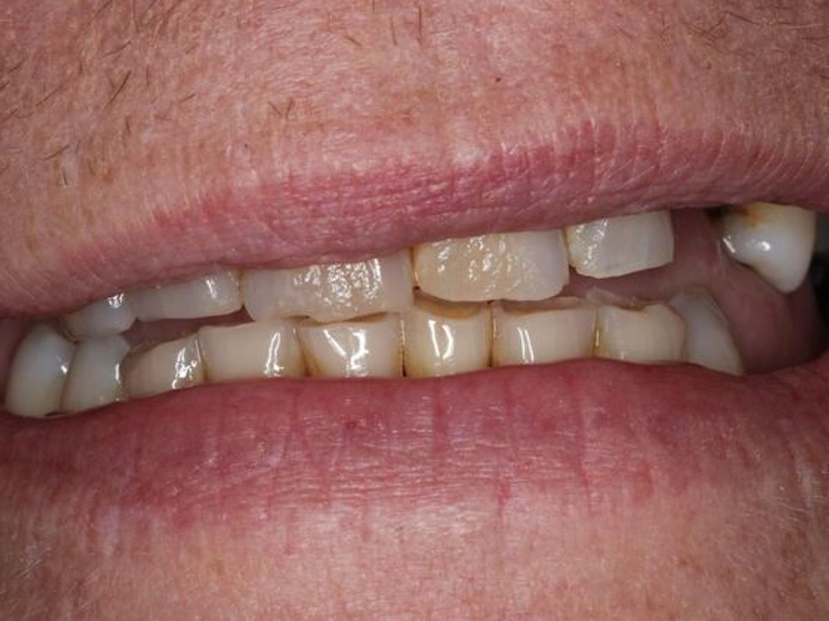 Dentures: Case 16 — before