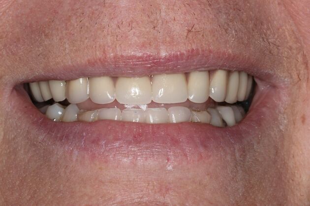 Dentures: Case 16 — after
