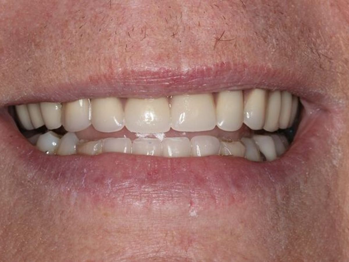 Dentures: Case 16 — after