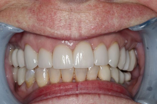 Veneers: Case 7 — after