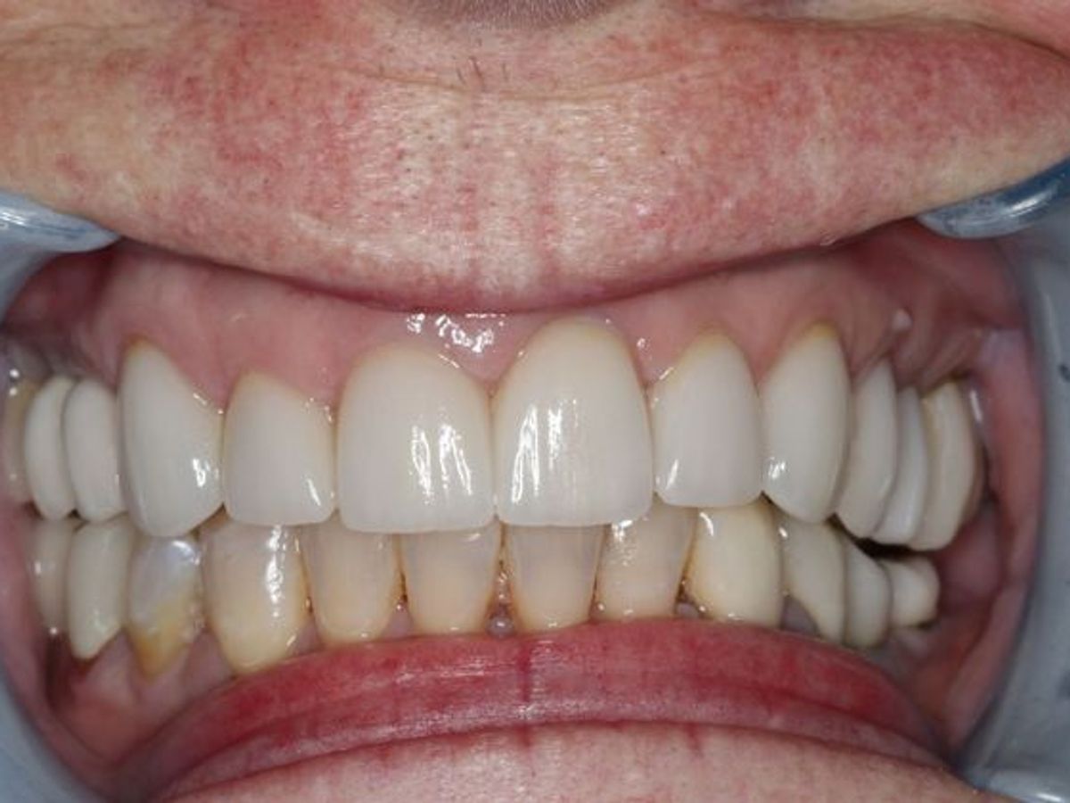 Veneers: Case 7 — after