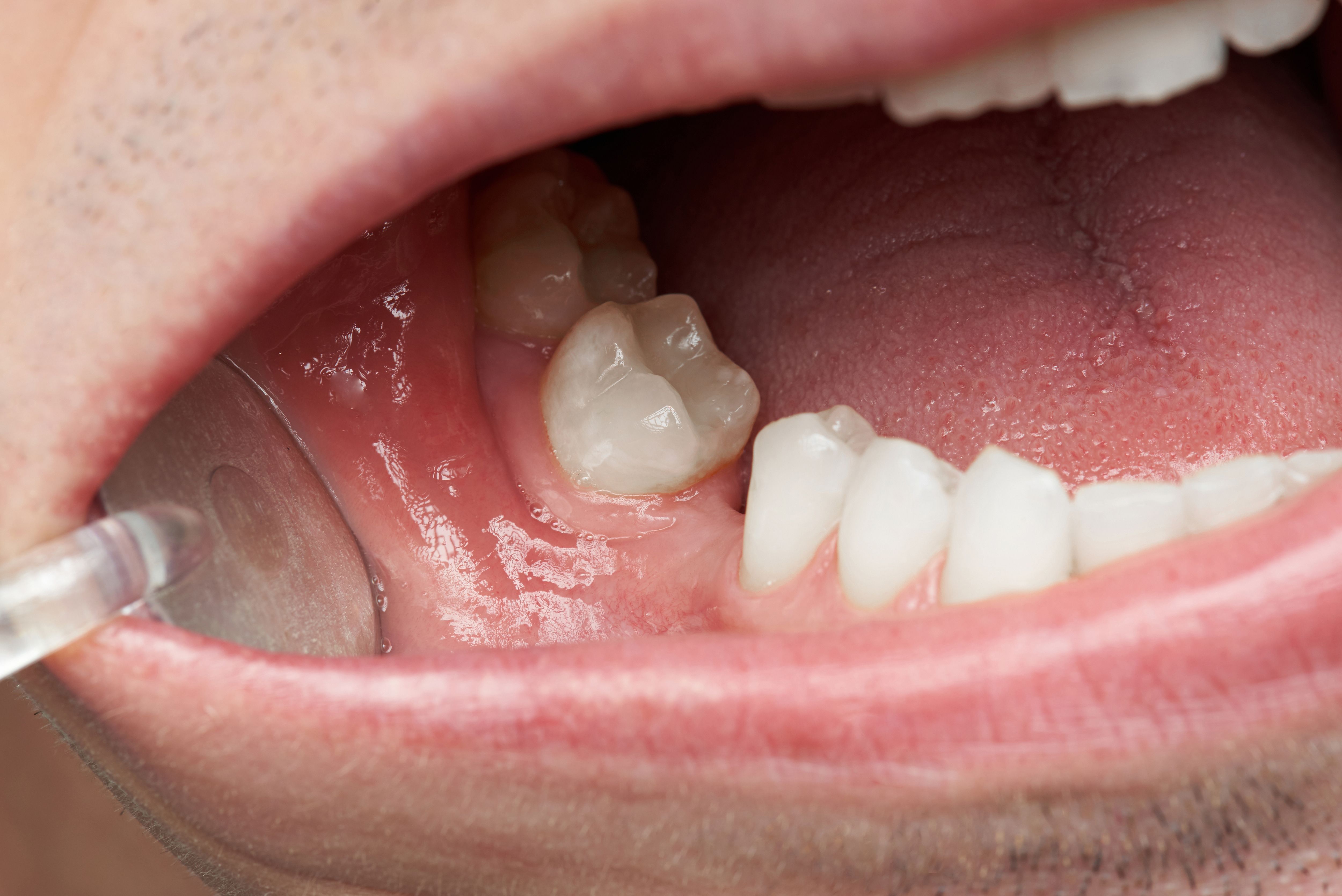 Missing Teeth and Jawbone Loss