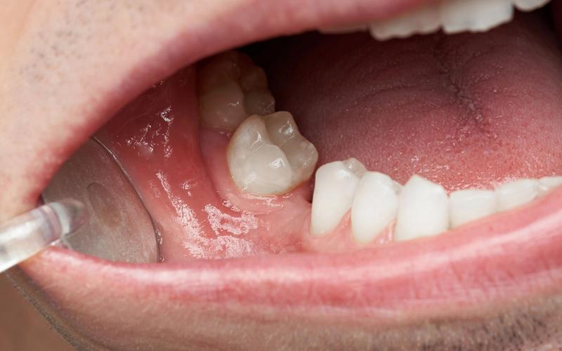 Missing Teeth and Jawbone Loss