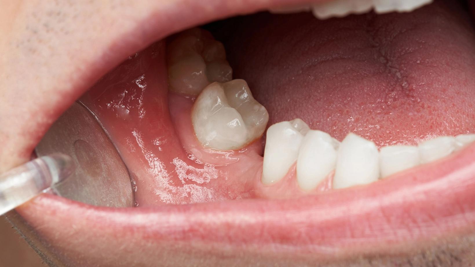 Missing Teeth and Jawbone Loss