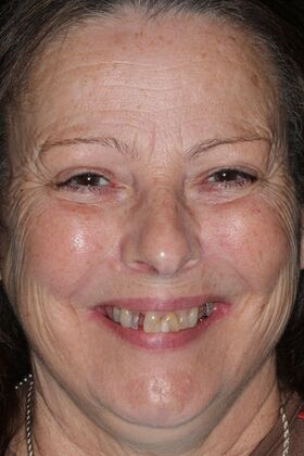 Teeth in a Day: Case 26 - before