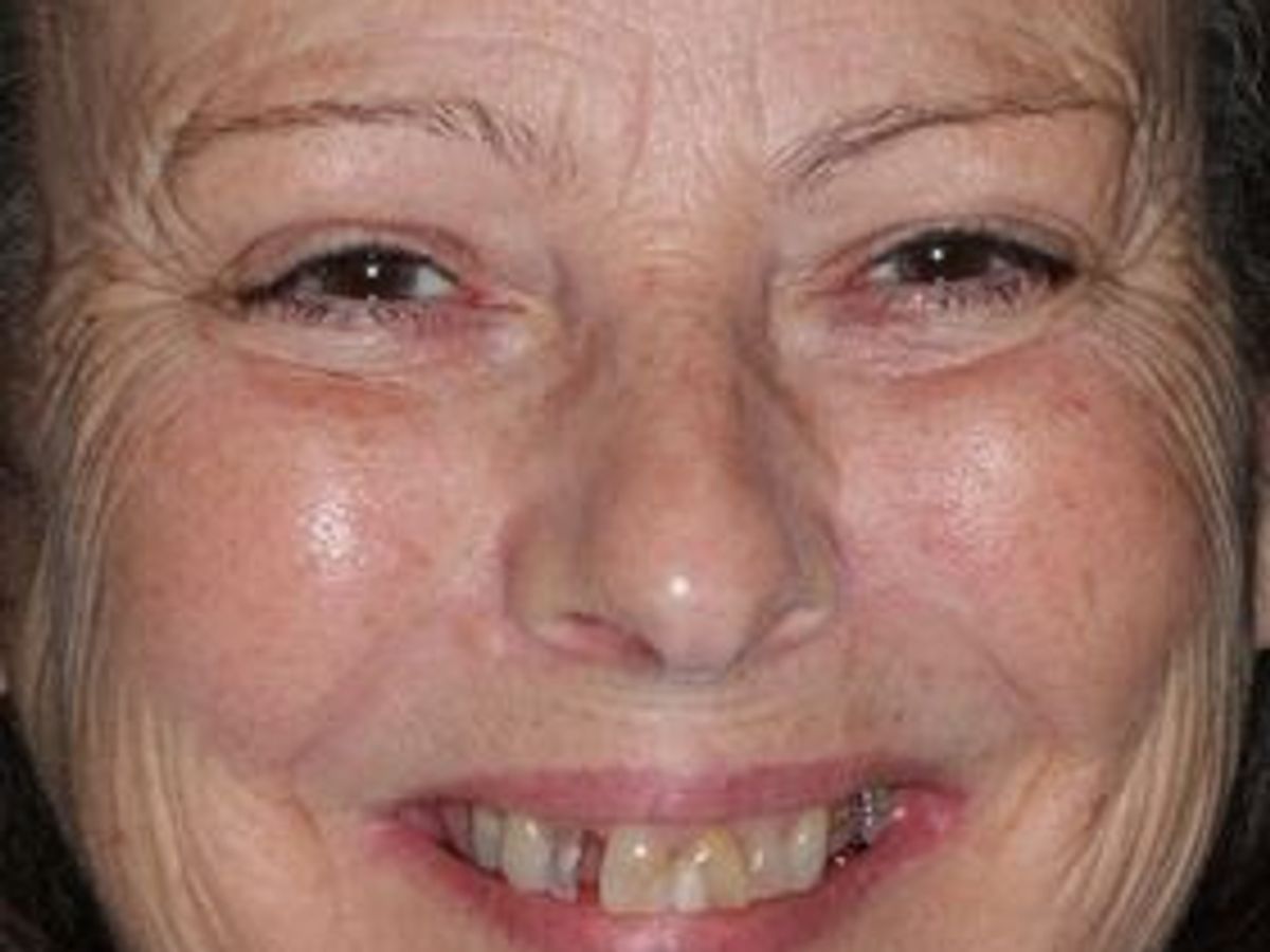 Teeth in a Day: Case 26 — before