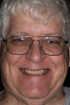 Veneers: Case 33 — after