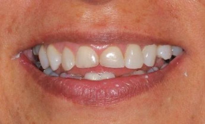 Veneers: Case 16 — before