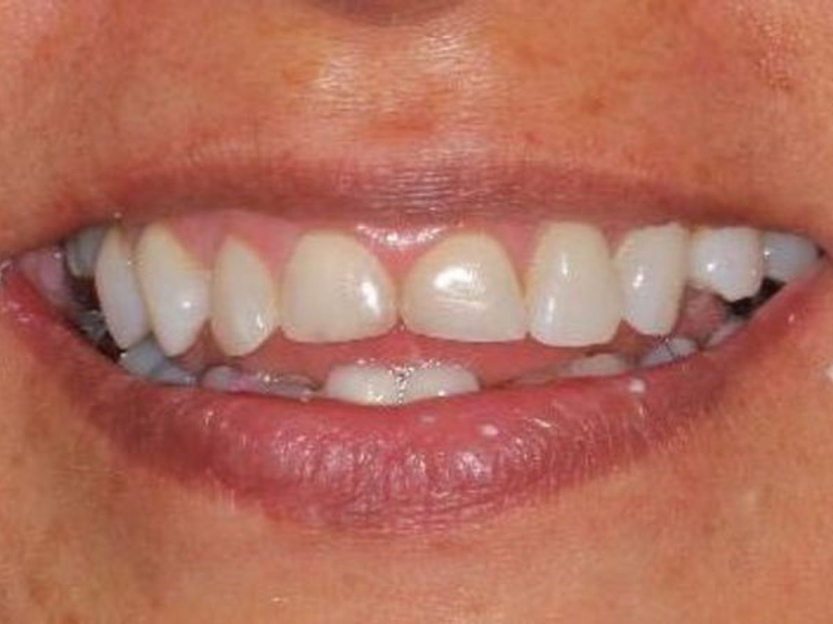 Veneers: Case 16 — before