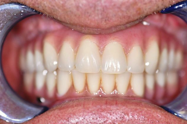 Teeth in a Day: Case 15 — Upper and Lower Arch before