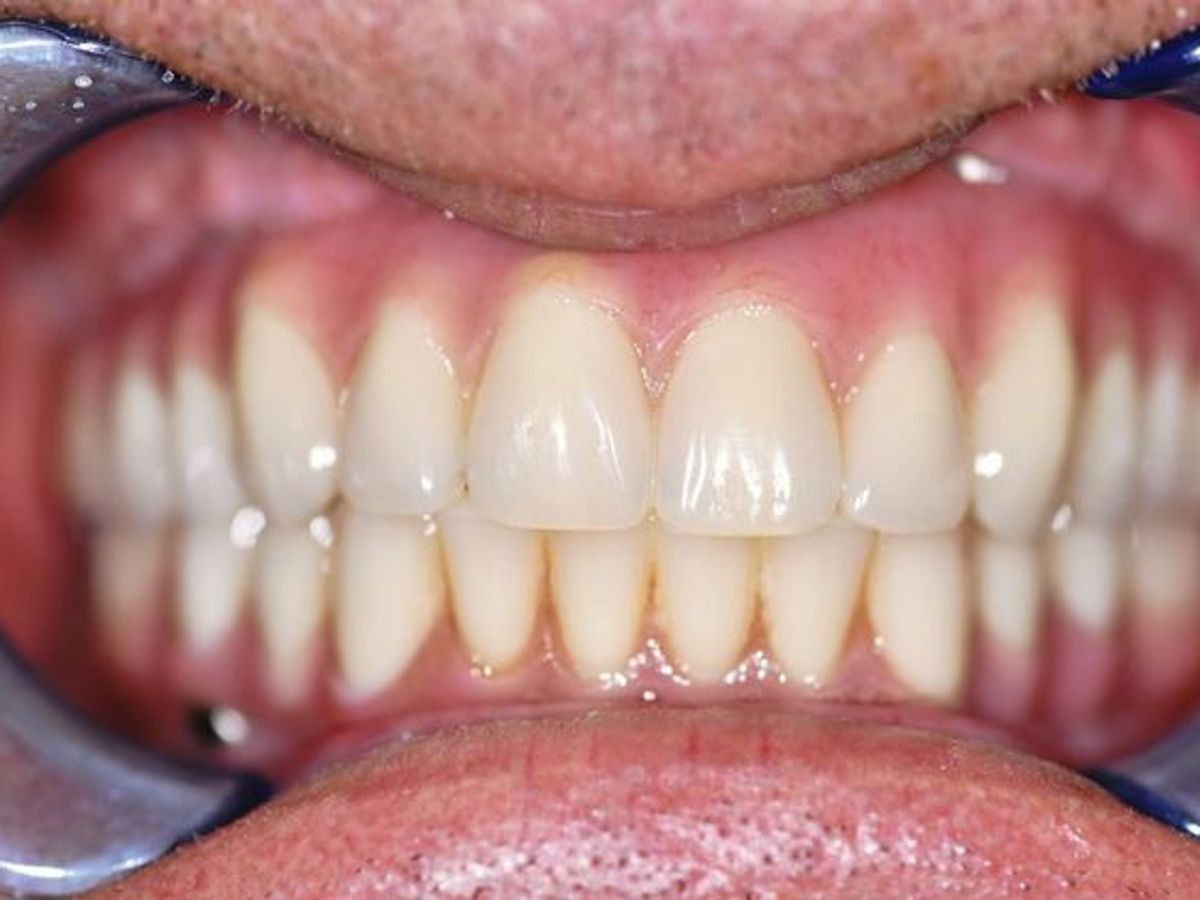 Teeth in a Day: Case 15 — Upper and Lower Arch before