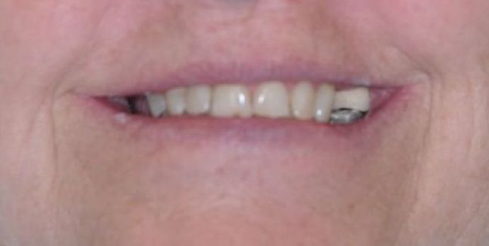Teeth in a Day: Case 10 — Restoration after