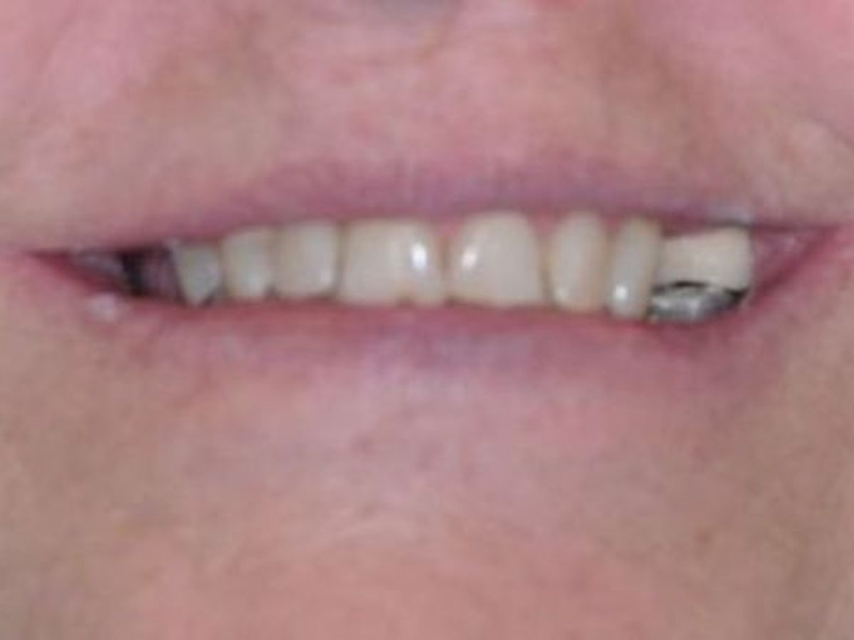 Teeth in a Day: Case 10 — Restoration after