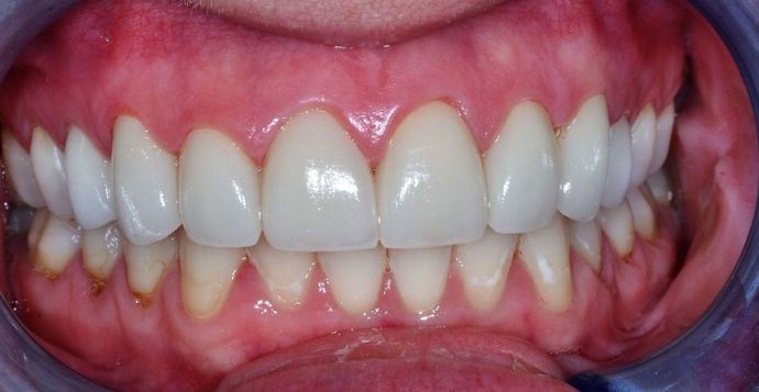 Dental Crowns: Case 20 — after
