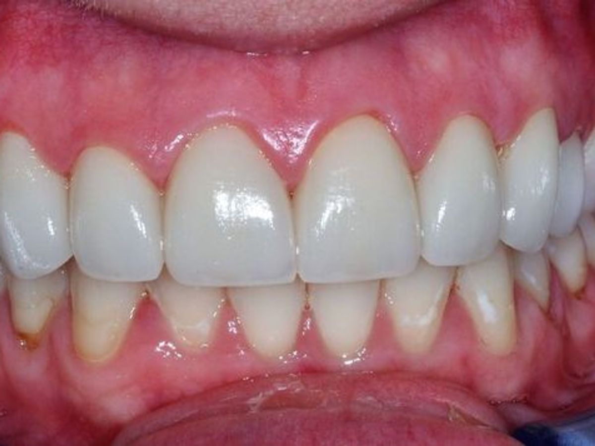 Dental Crowns: Case 20 — after