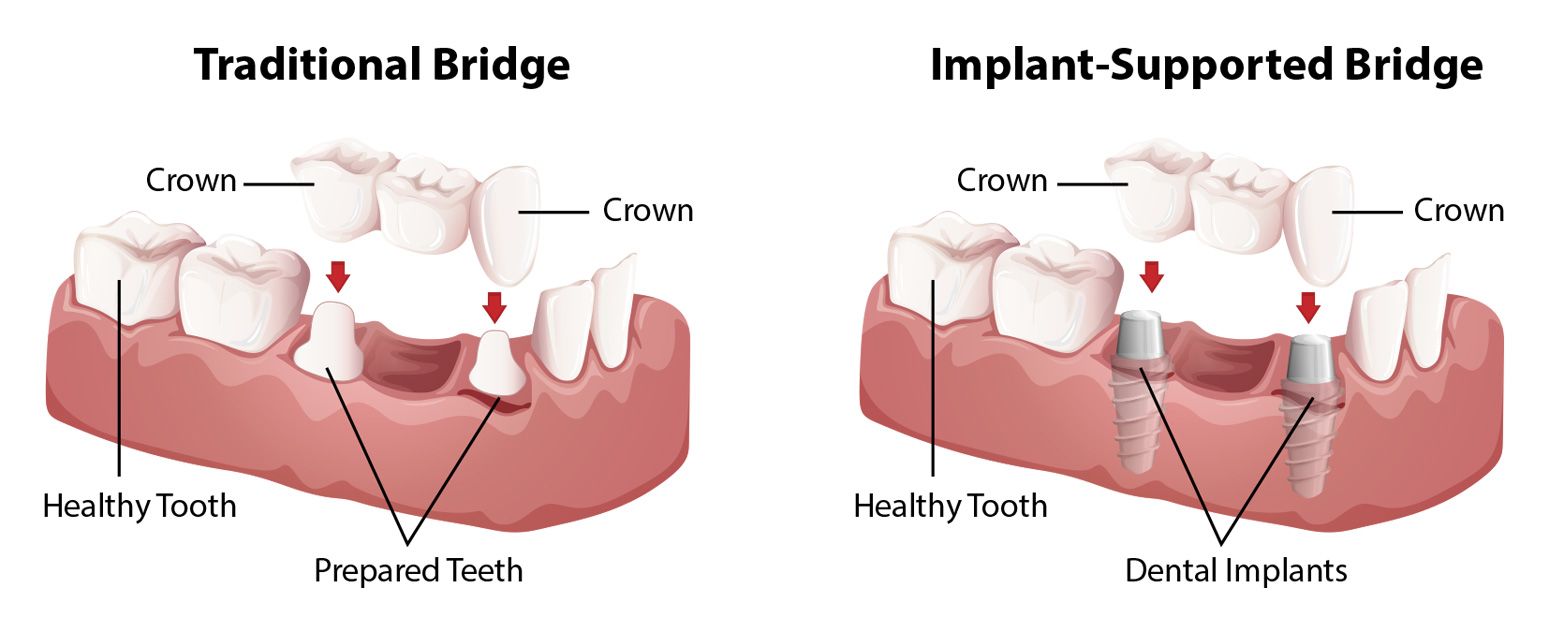 Implant-supported vs. Traditional Dental Bridges