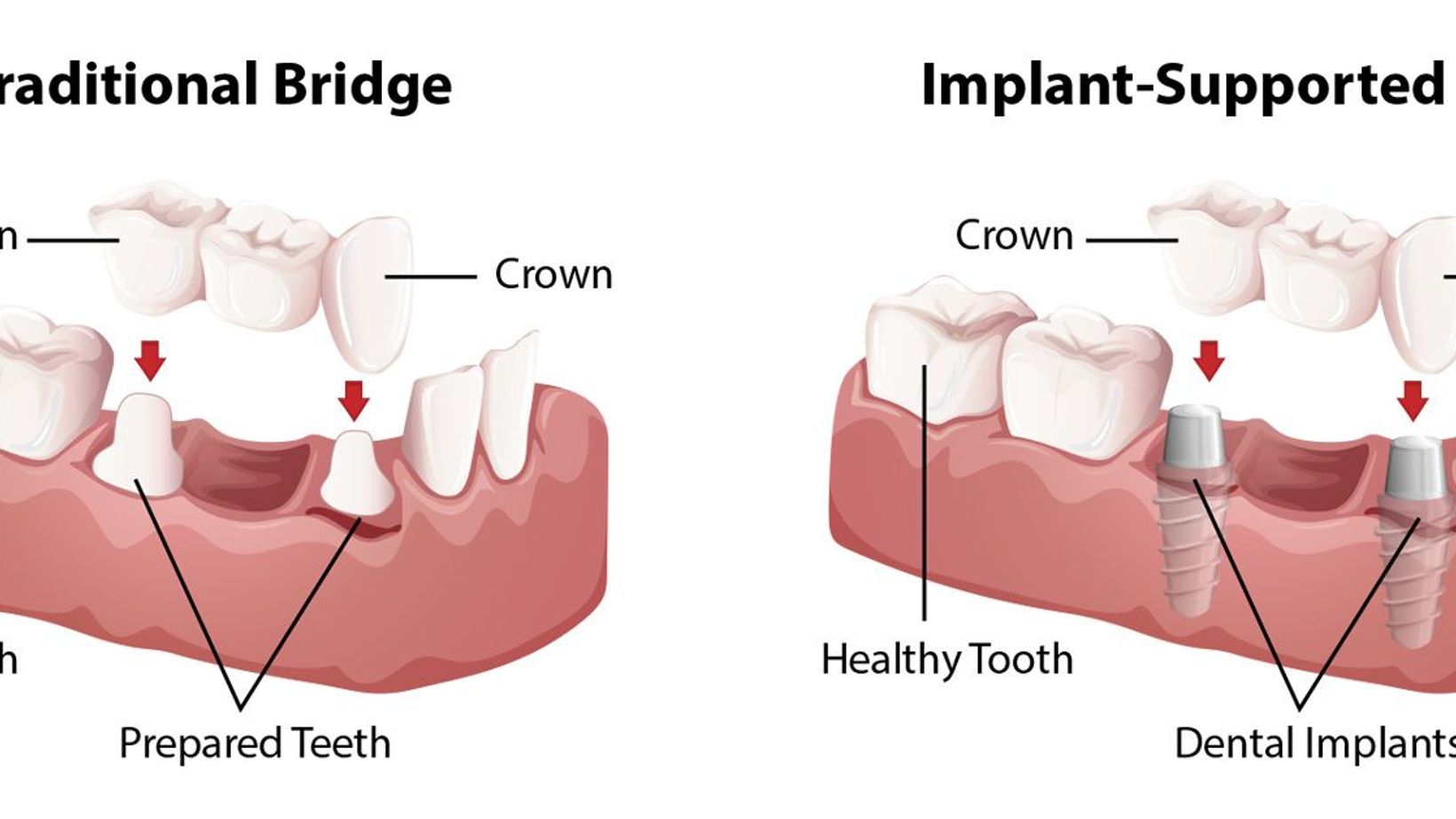 Implant-supported vs. Traditional Dental Bridges
