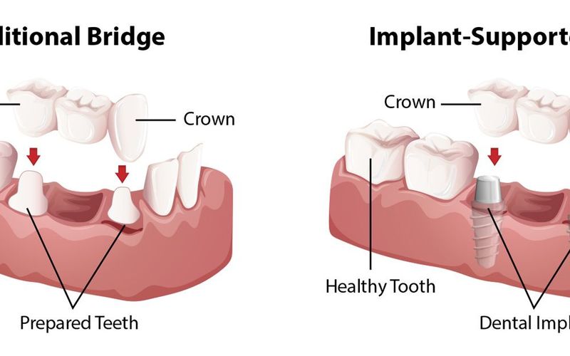 Implant-supported vs. Traditional Dental Bridges