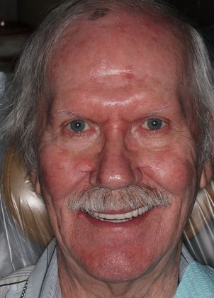 Dentures: Case 10 — after