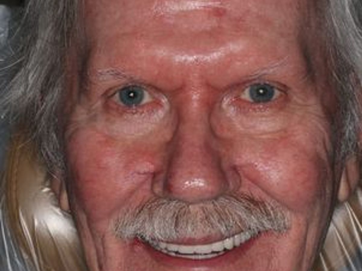 Dentures: Case 10 — after
