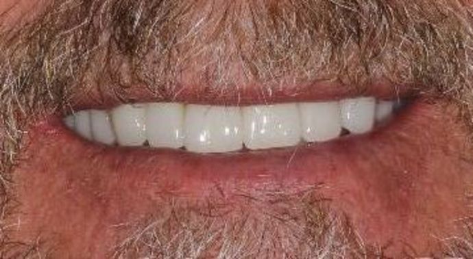 Dental Crowns: Case 29 — after