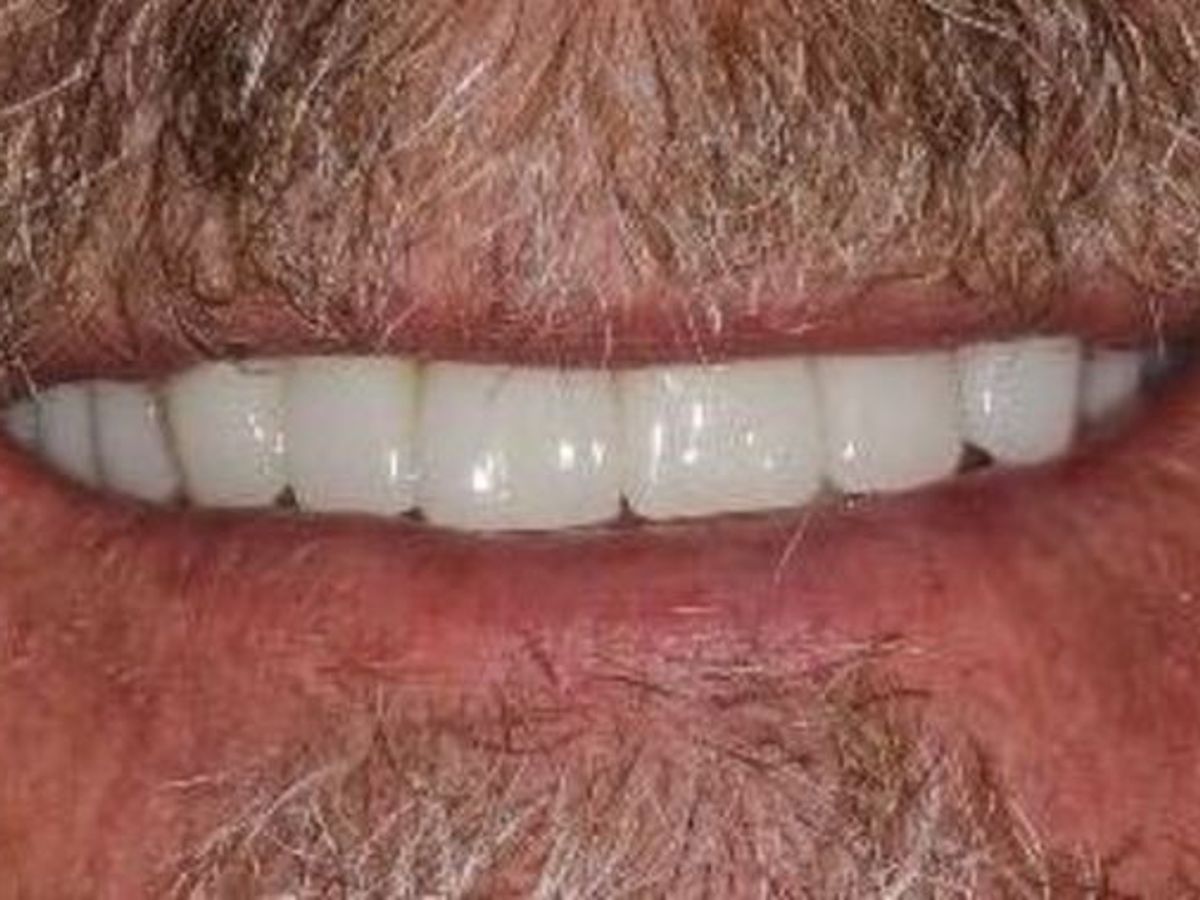 Dental Crowns: Case 29 — after