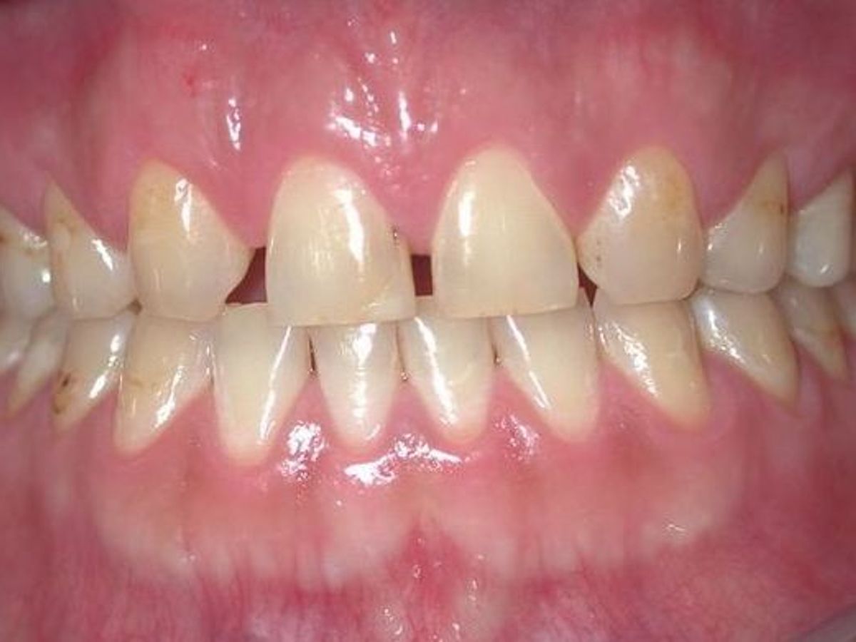 Veneers: Case 3 — before