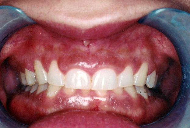 Gum Lift: Case 1 - Before (Retractors)