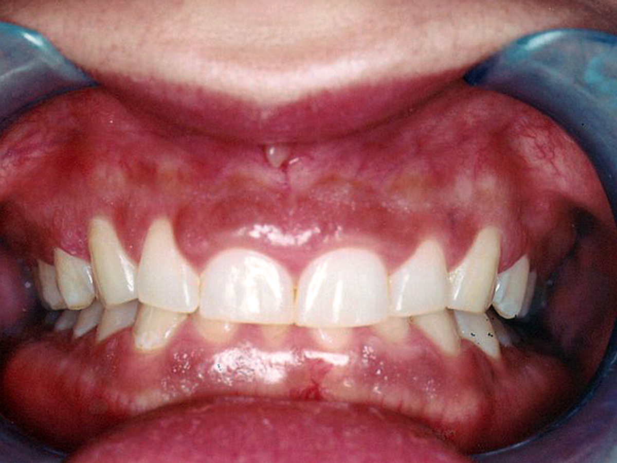 Gum Lift: Case 1 — Before (Retractors) / After (Retract) before