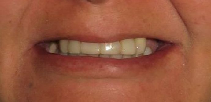 Teeth in a Day: Case 18 — before