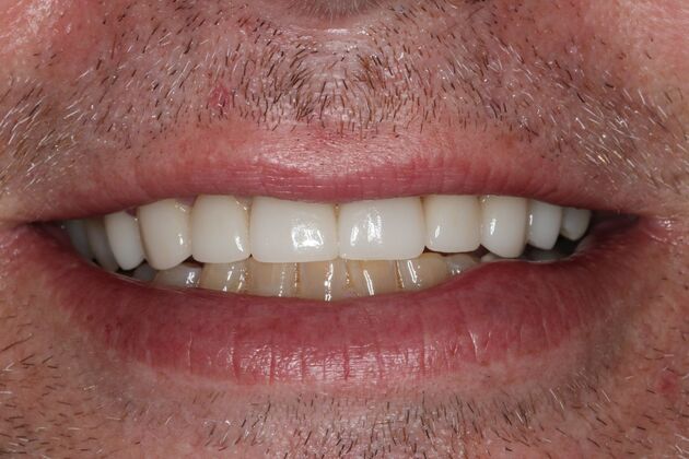 Veneers: Case 35 — after