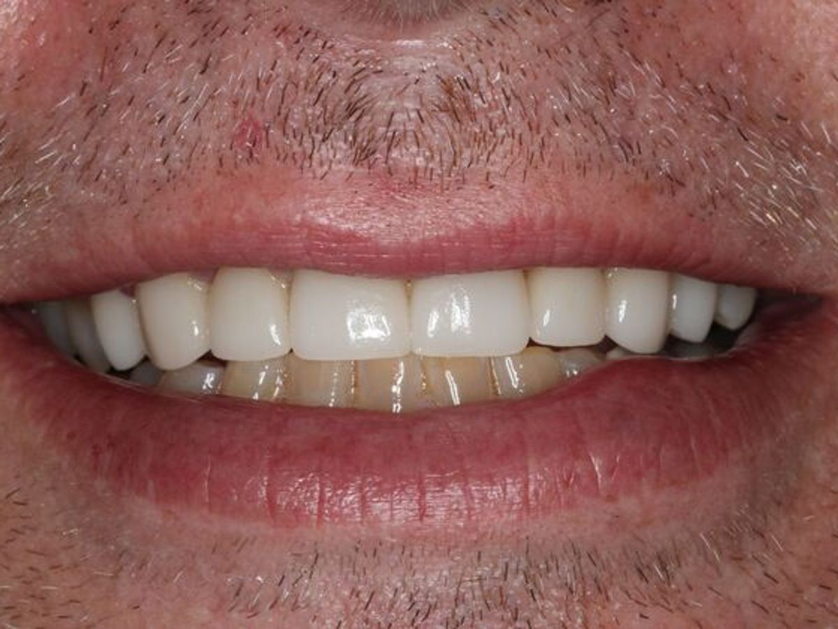 Veneers: Case 35 — after