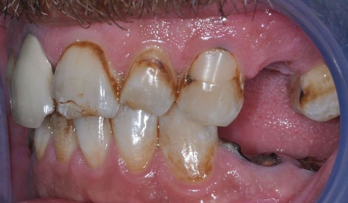 Dental Implants: Case 2 — before