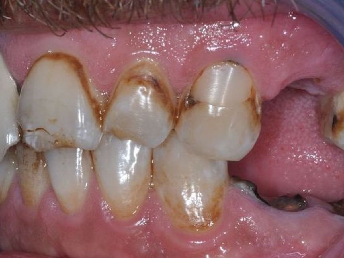 Dental Implants: Case 2 — before