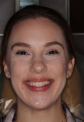 Veneers: Case 25 — before