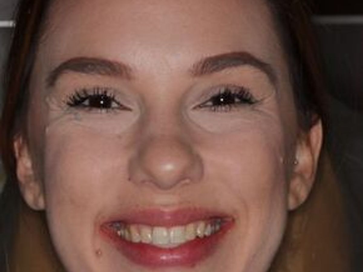 Veneers: Case 25 — before