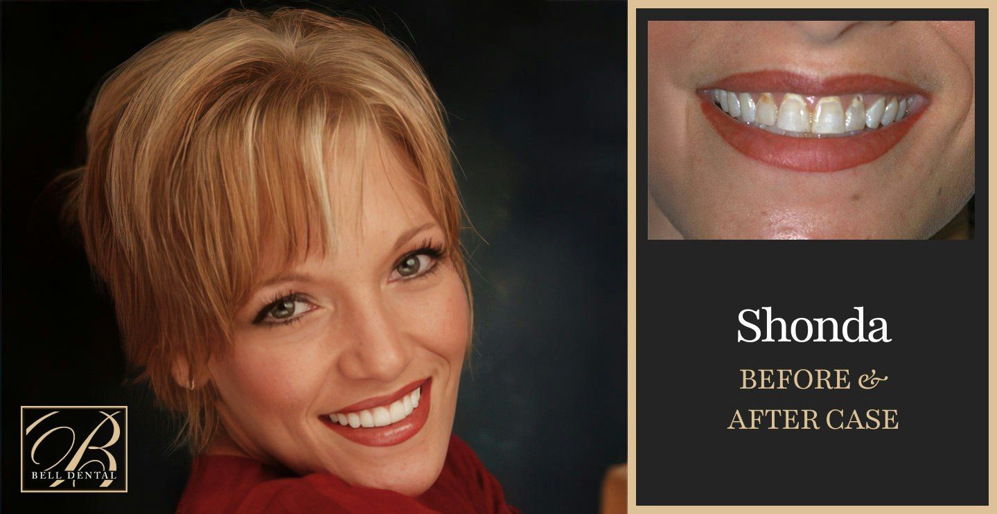 Before and after — veneers and crowns